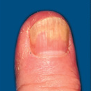 Discolouration of nails