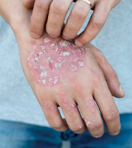 psoriasis hands