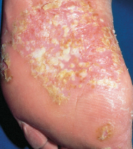 psoriasis feet