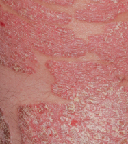psoriasis face