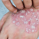 Skin with red patches