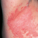 Inflamed